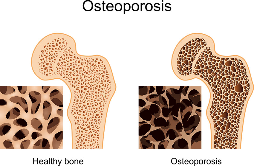 Building Strong Bones: The Essential Role of Vitamin D and Calcium